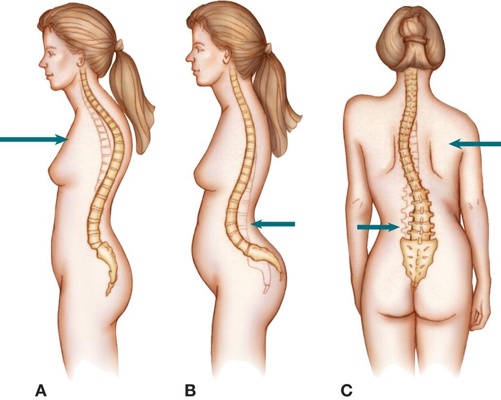 Three abnormal curvatures of the spine: (A) kyphosis; (B) lordosis; (C) scoliosis.