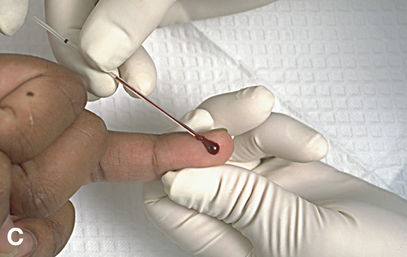 Performing a Capillary Puncture (Manual) 