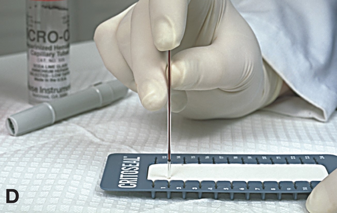 Performing a Capillary Puncture (Manual) 