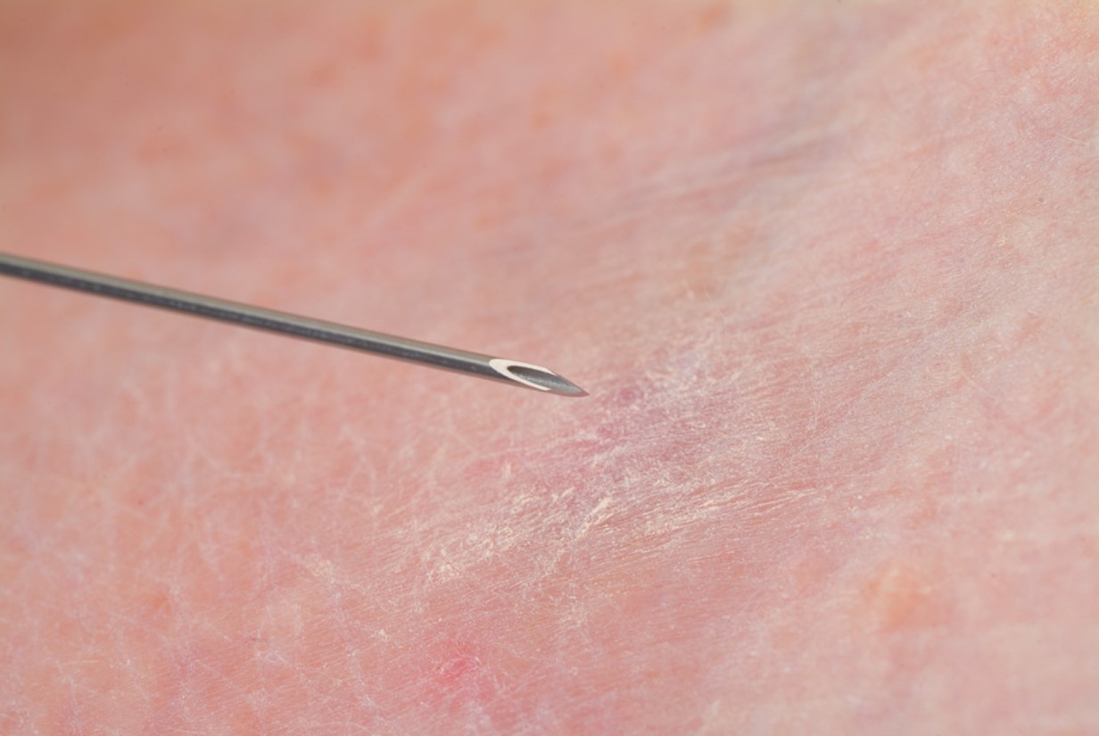 A beveled tip helps the needle penetrate skin and vein with minimal damage.