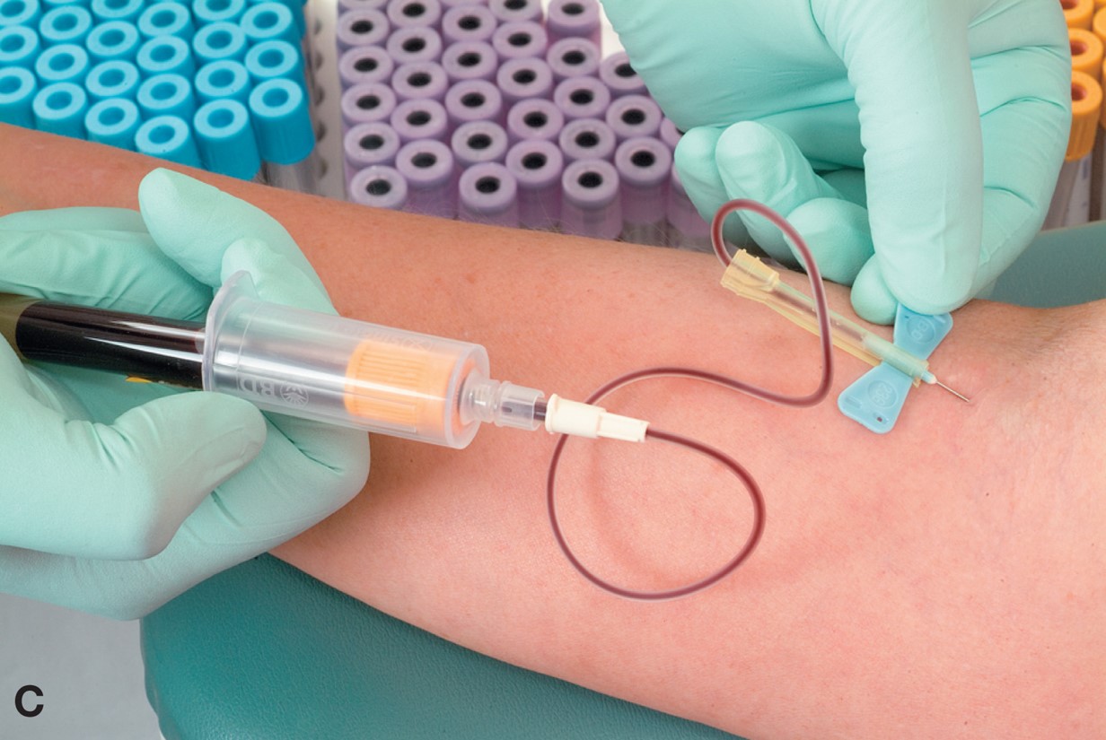 Demonstrating the use of venipuncture equipment. Holding a butterfly needle in place with a ...