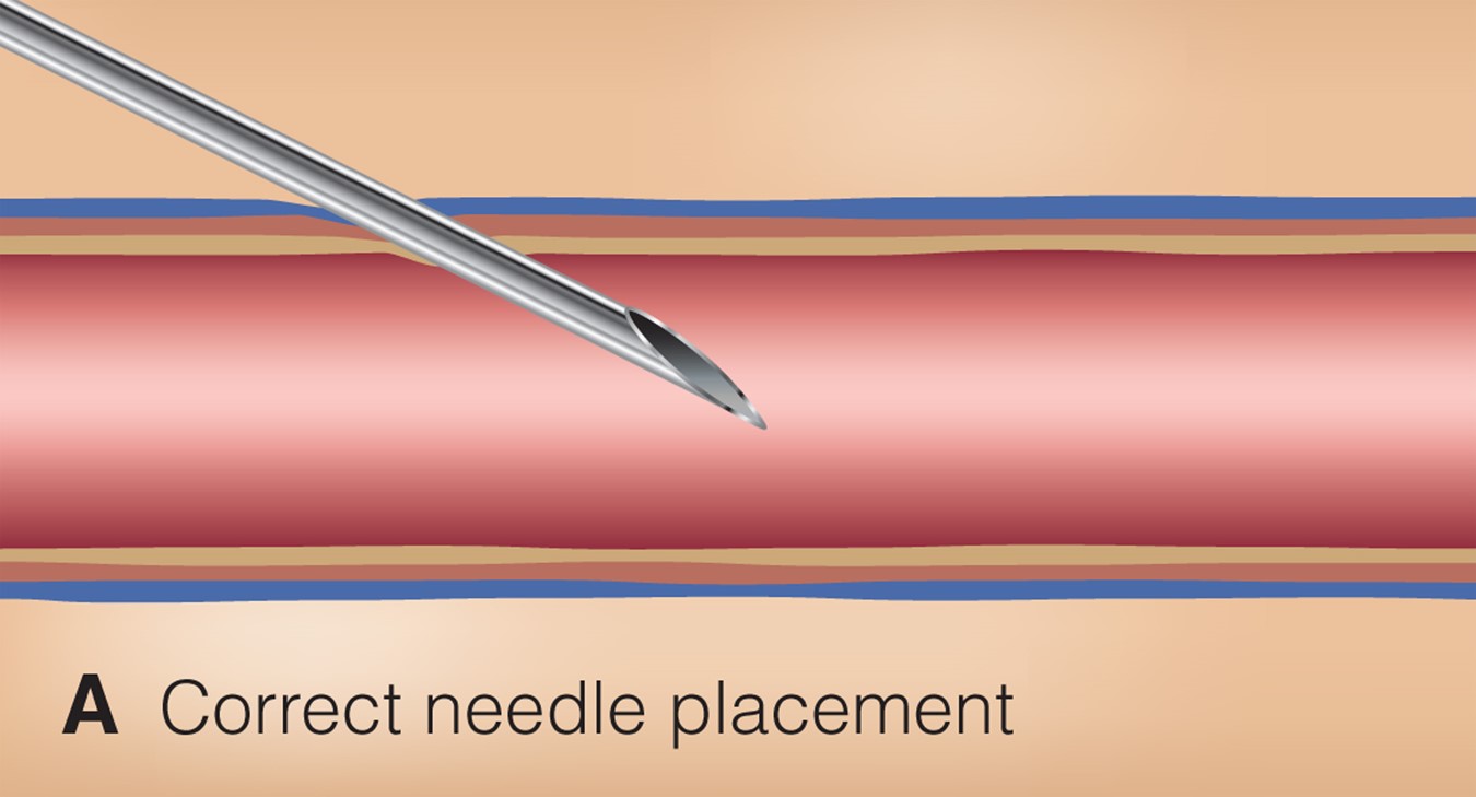 Common phlebotomy issues.