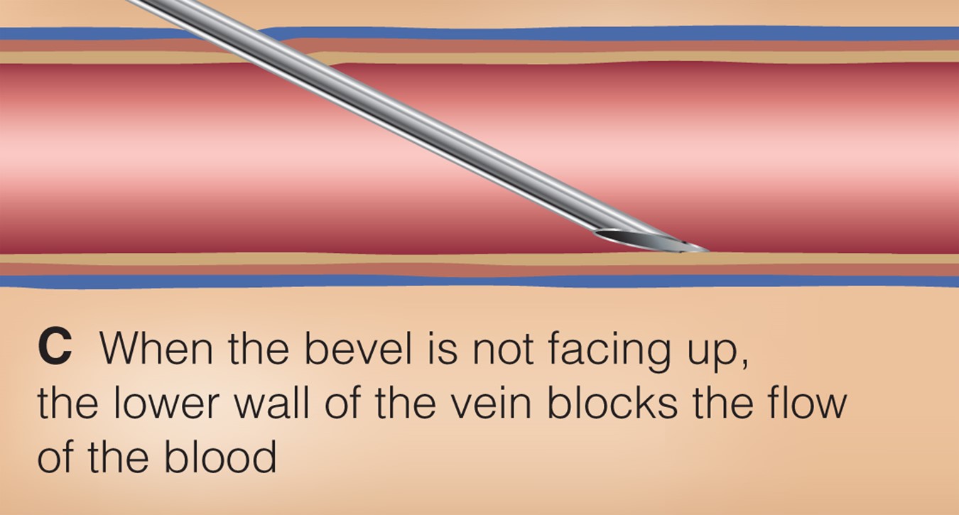 Common phlebotomy issues.