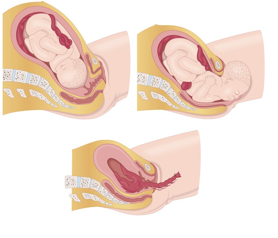 (A) Dilation stage: uterine contractions cause dilation of the cervix; (B) expulsion stage: birth, ...