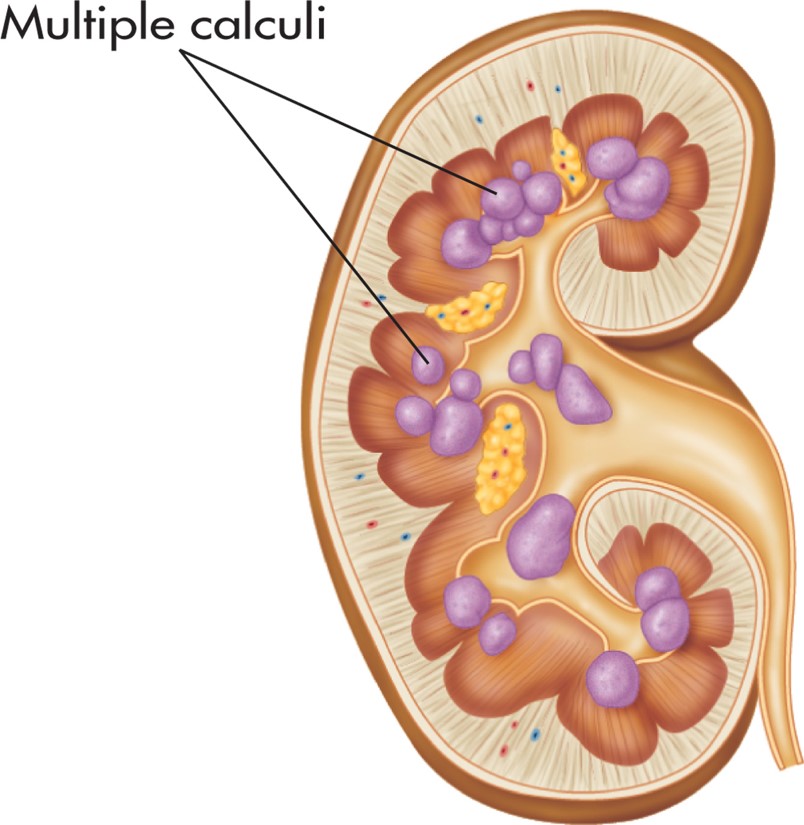 Multiple urinary calculi.