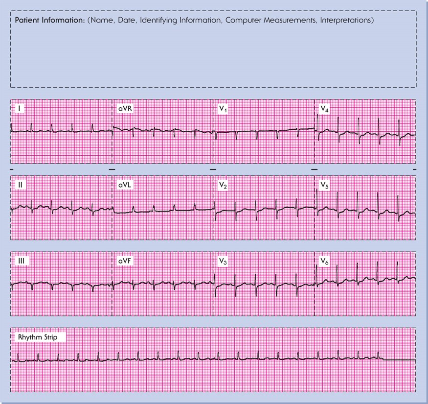 A properly mounted 12-lead, single channel ECG.