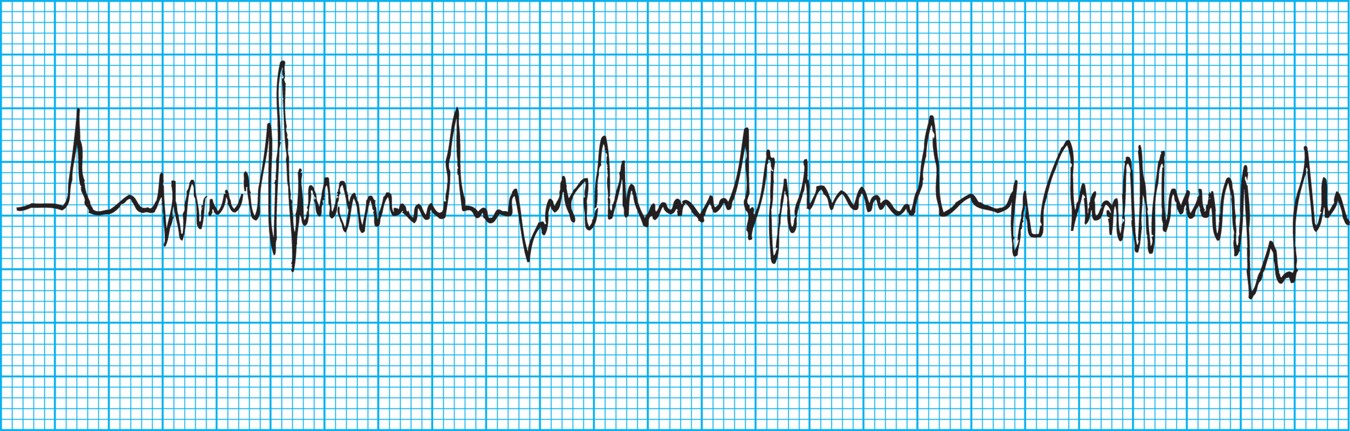 Somatic tremors artifact.