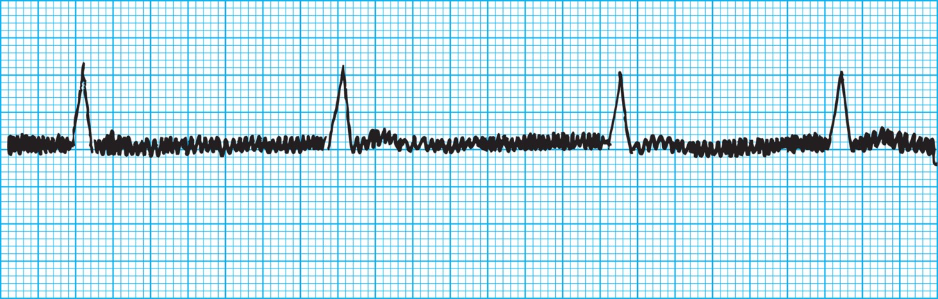 60-cycle interference.