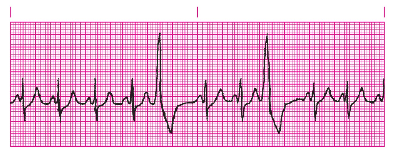 Multifocal premature ventricular contractions (PVCs).