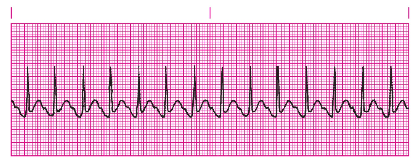 Sinus tachycardia.