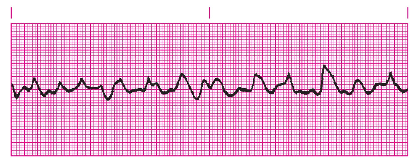 Ventricular fibrillation.