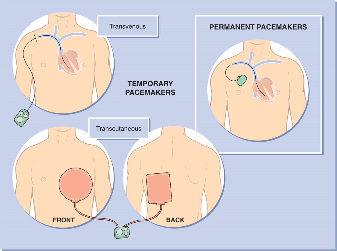 Temporary and permanent pacemakers.