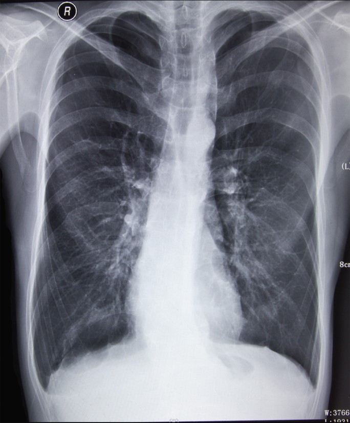 Chest X-ray of a patient with emphysema. 