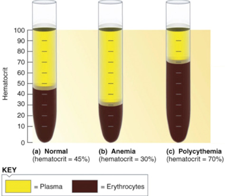 Hematocrits, left to right: normal, anemia, polycythemia.