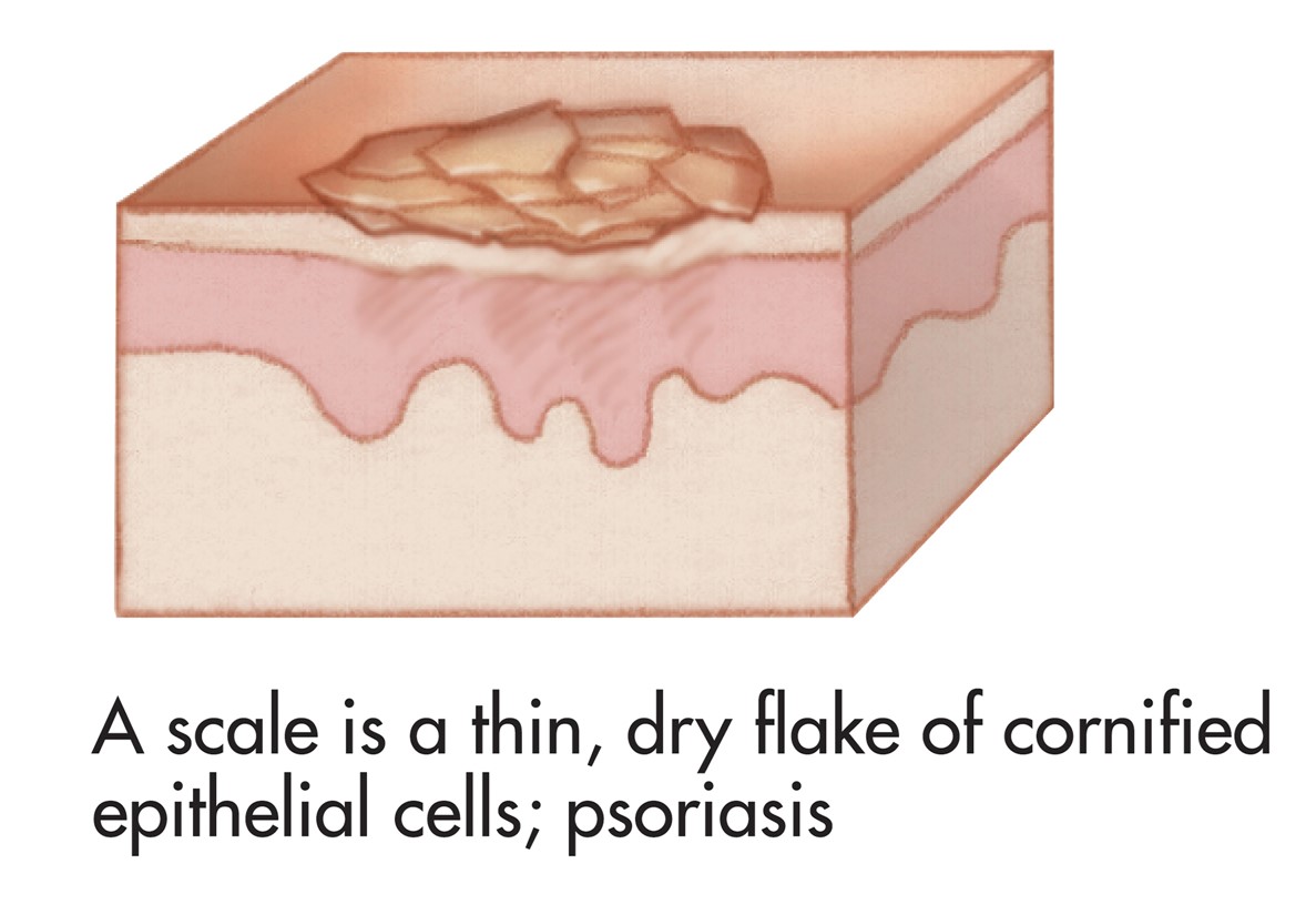 Common skin signs are often evidence of an illness or disorder. A scale is a thin, dry flake of ...