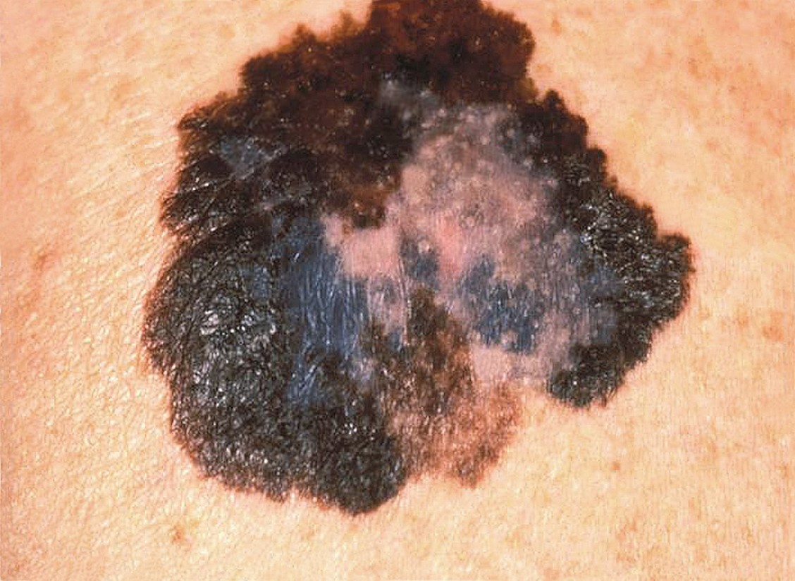 Melanoma