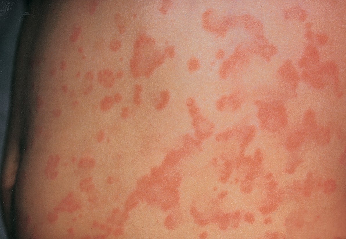 Urticaria (hives).