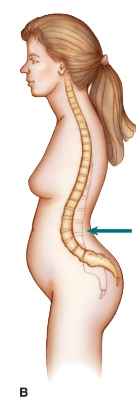 Lordosis