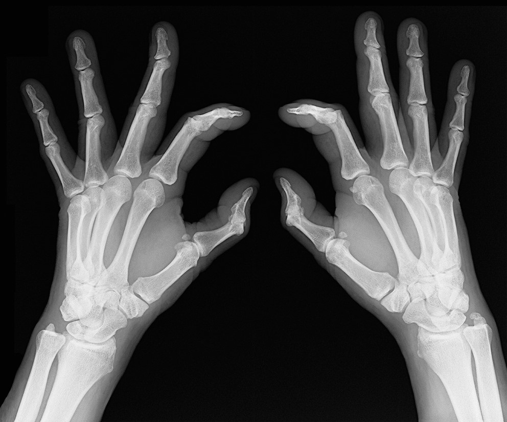 X-ray showing typical joint changes with osteoarthritis. 