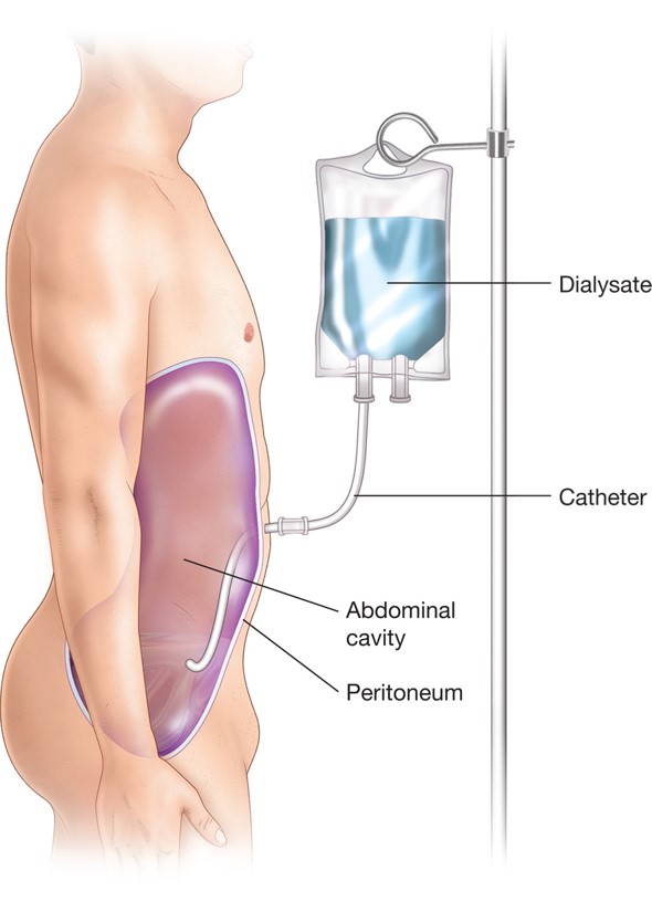 Peritoneal dialysis.