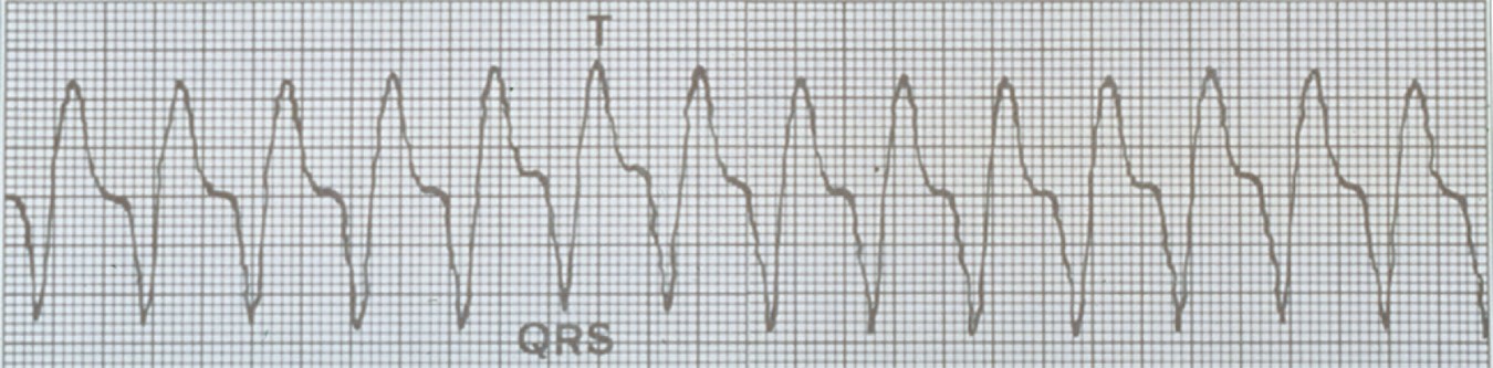 Examples of heart rhythms: ventricular tachycardia.