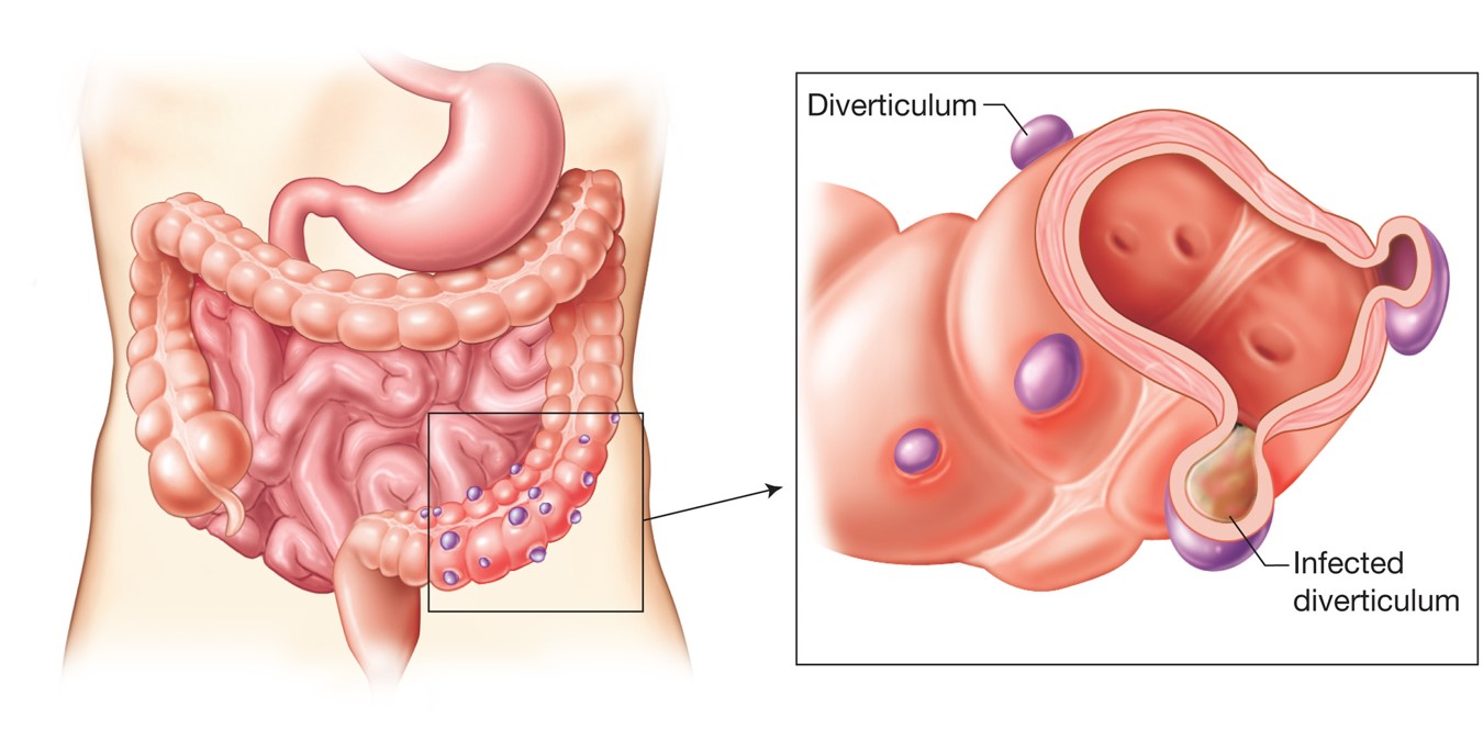 Colon with diverticulosis. An inflamed or infected diverticulum is called diverticulitis.