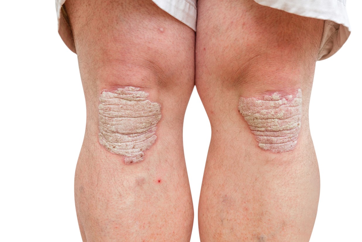 Bilateral psoriasis on a patient’s knees. 