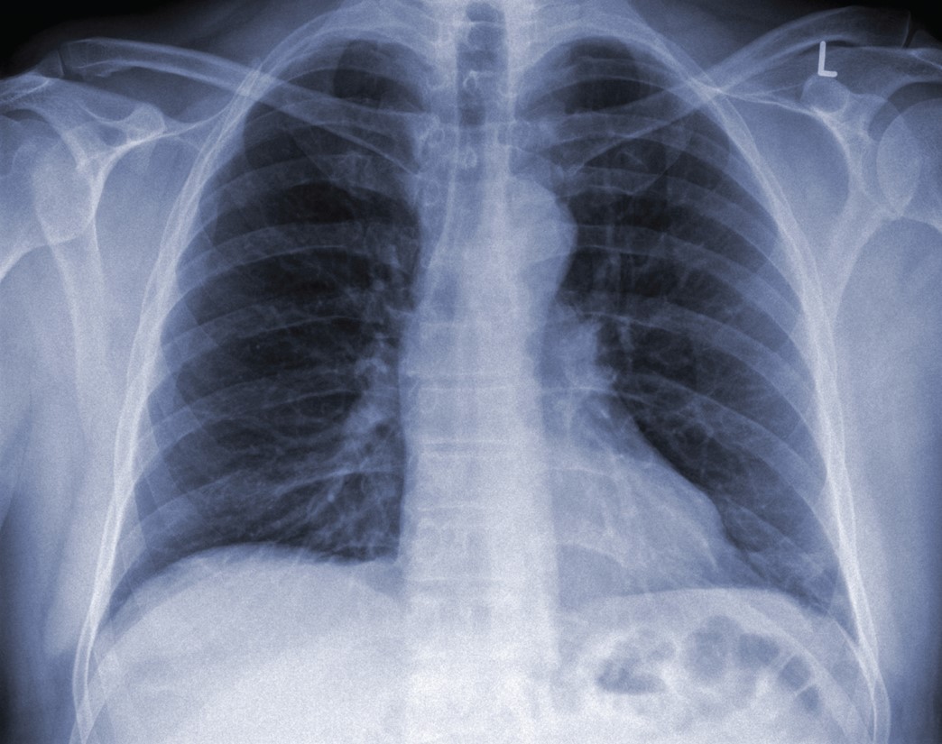 An X-ray showing pneumonia.