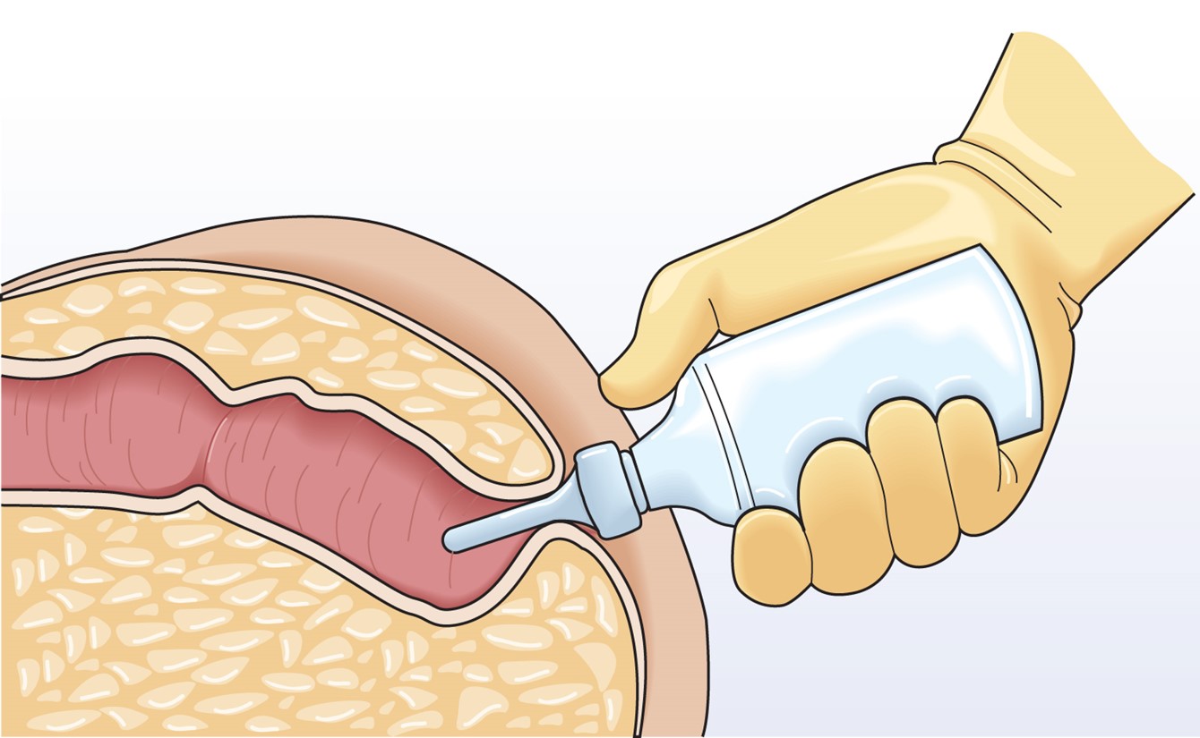 Administering a Disposable Enema