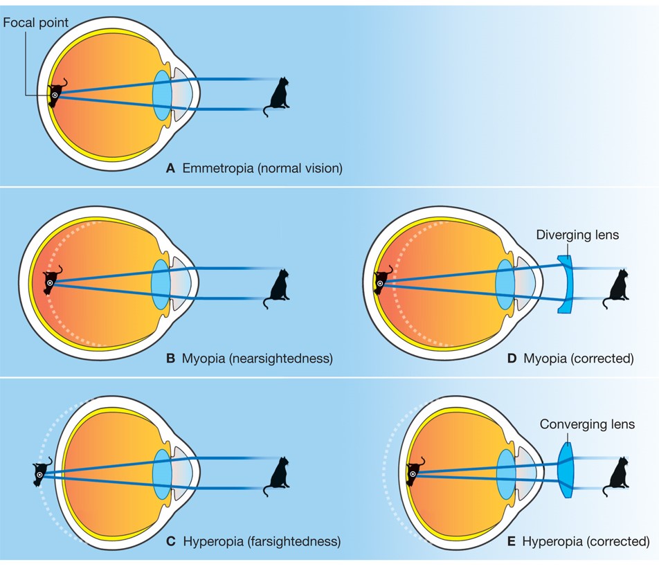 How lenses correct visual problems: (A) emmetropia; (B) myopia; (C) hyperopia; (D) corrected myopia; ...