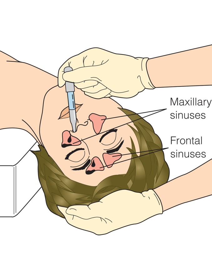 Instilling Nasal Medications