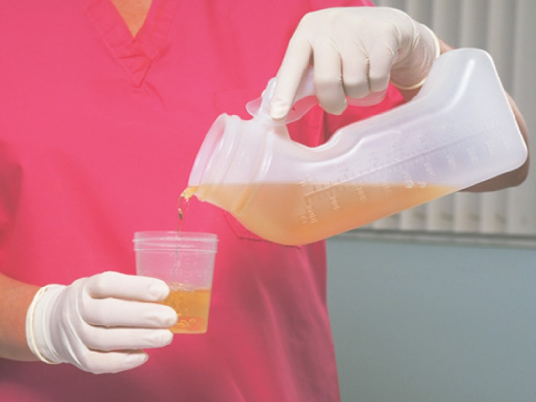 Collecting a 24-Hour Urine Specimen