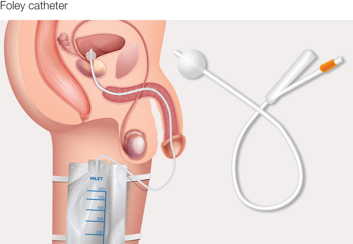 Types of catheters: Indwelling (Foley) catheter.