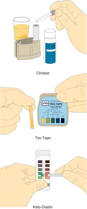 Three types of urine tests for checking patients’ urine for diabetes.