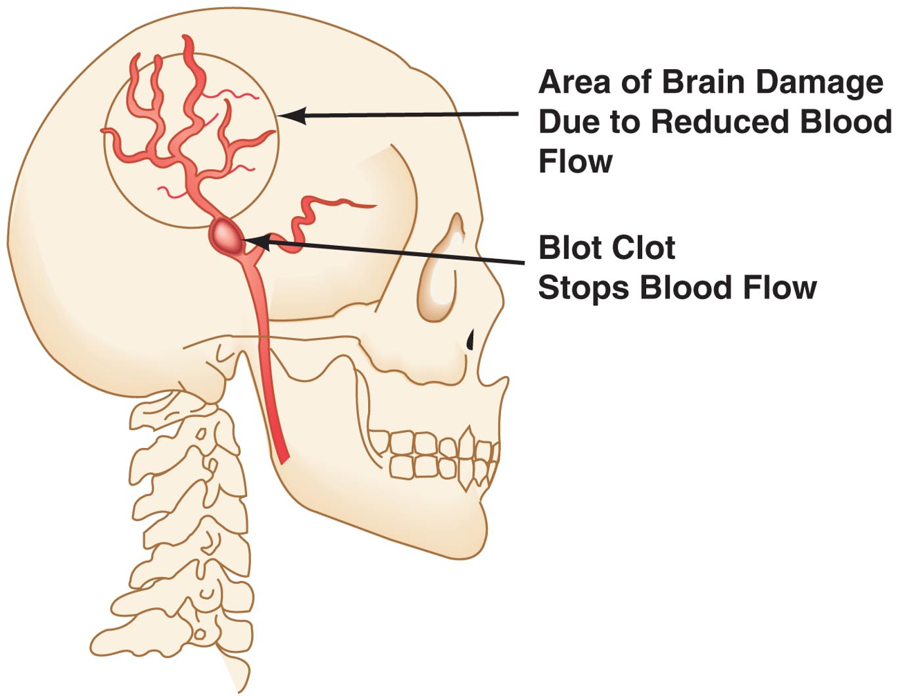 Blocked Artery Leading to Stroke