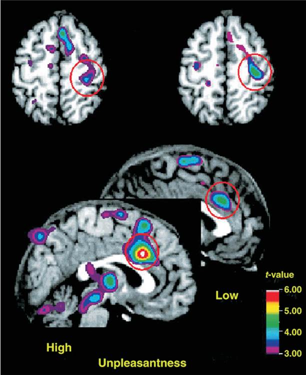 Sensory and Emotional Components of Pain 