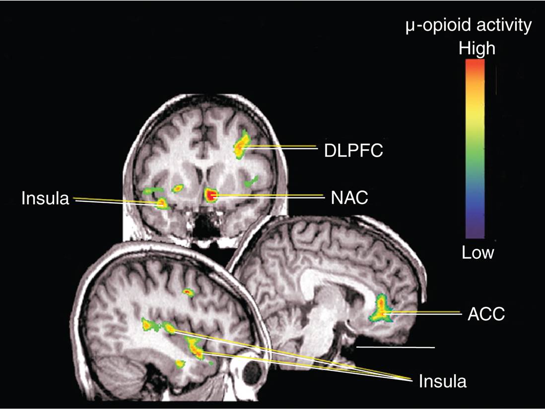 Effects of a Placebo on μ-Opioid Neurotransmission 