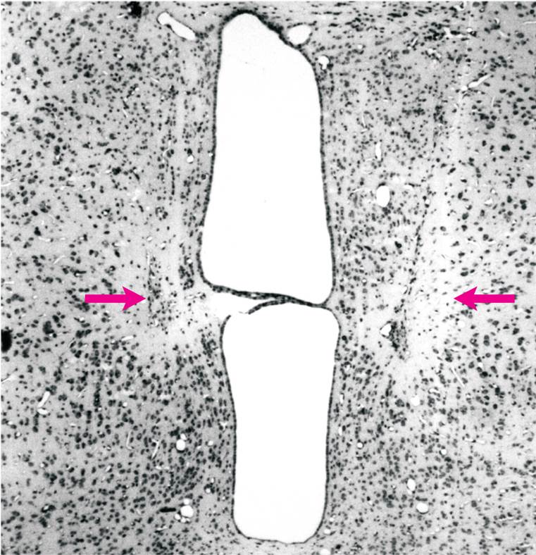 Radio Frequency Lesion