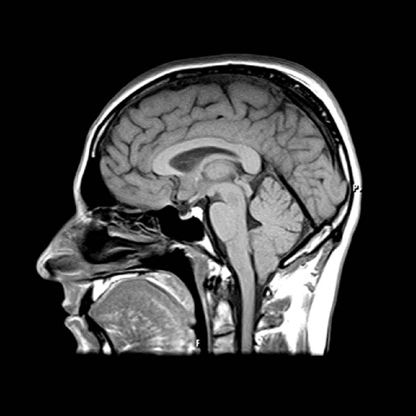 Midsagittal MRI Scan of a Human Brain 