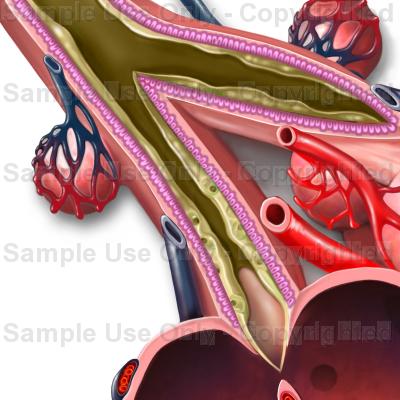 Mucus block in bronchiole