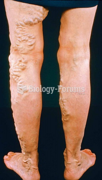 Severe varicose veins in the leg.