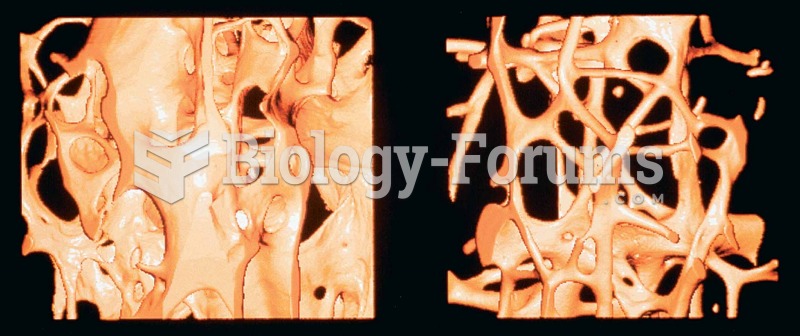 Normal bone versus bone with osteoporosis.