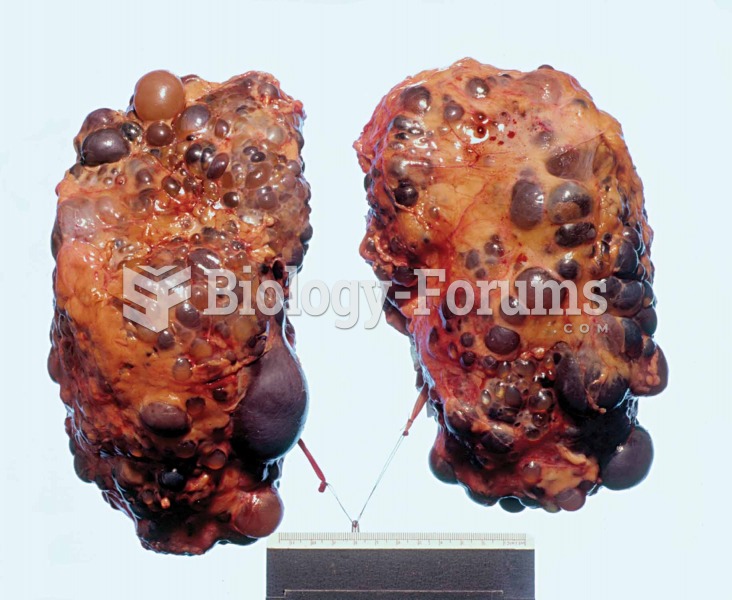 Polycystic kidney disease.