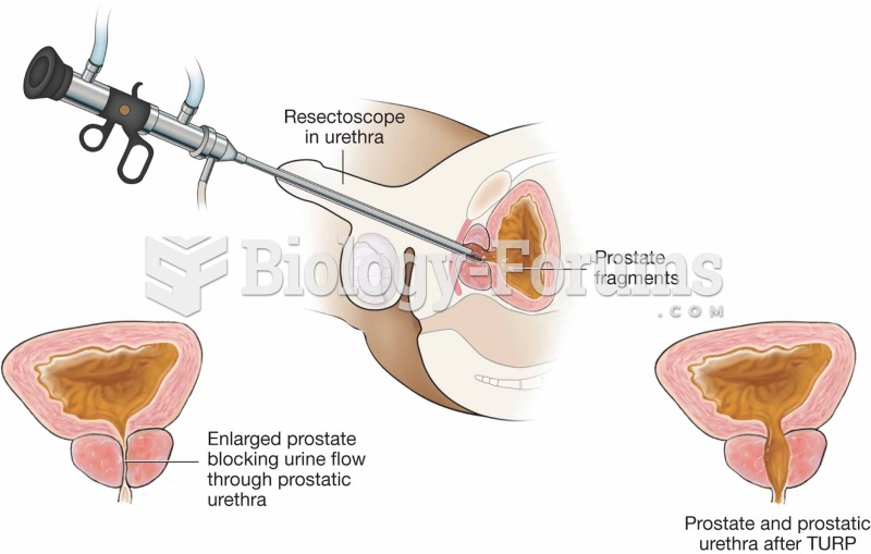 Transurethral resection of the prostate (TURP).