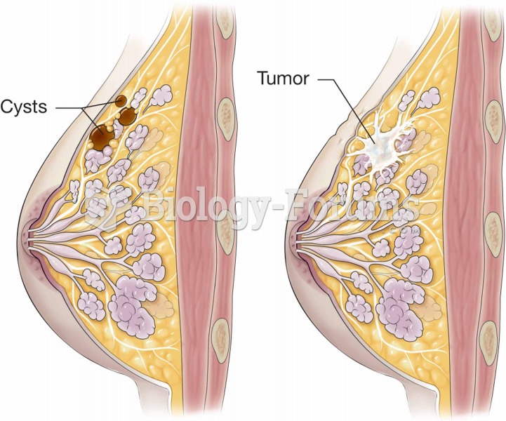 Breast with cancer and cysts.