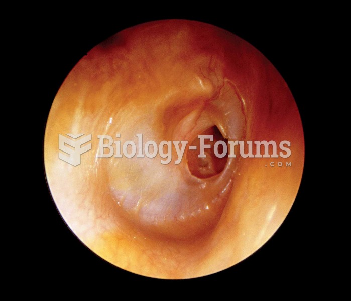 Perforated tympanic membrane.