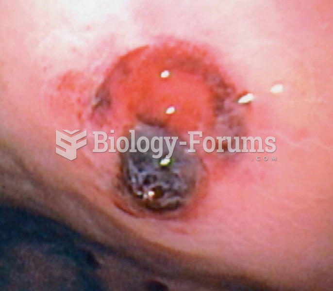 Gastric ulcer