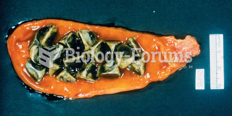 Gallstones in the biliary and pancreatic ducts