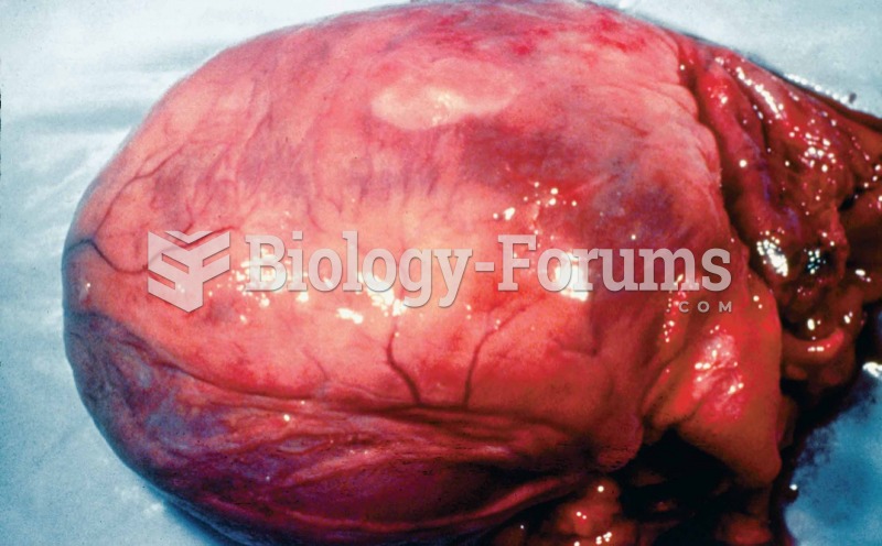 An enlarged heart showing the results of cardiomyopathy.