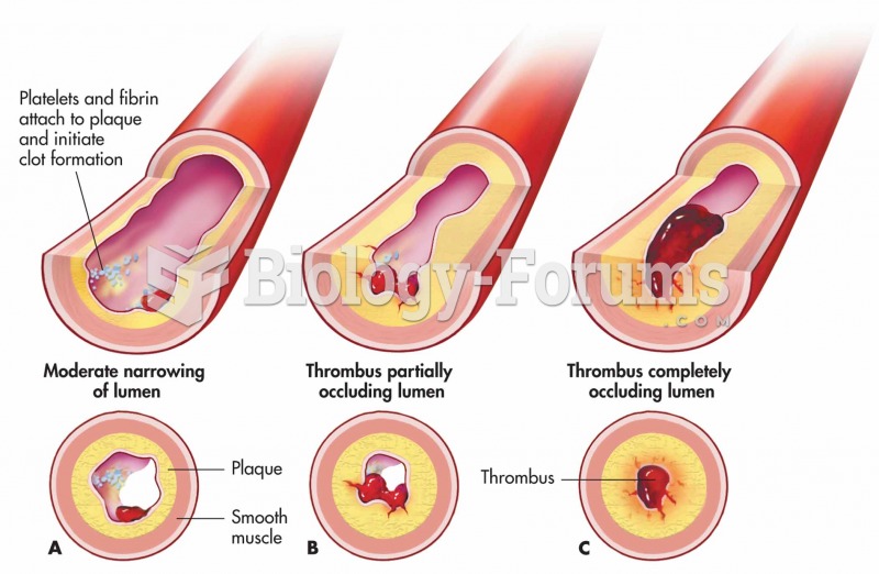 Thrombus formation in an atherosclerotic vessel